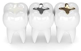 شیرین گلیکانلوی میلان -Shirin Glikanlouye Milan-Dental Filling- پرکردن دندان